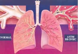 Astm bronsic - diagnostic, complicatii